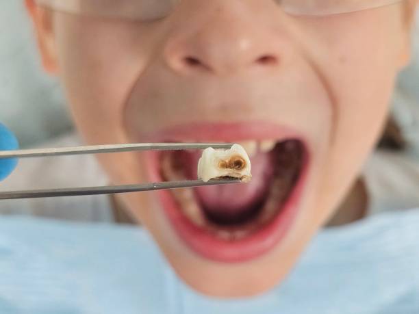 Best Emergency Dental Care for Abscessed Tooth in King Of Prussia, PA